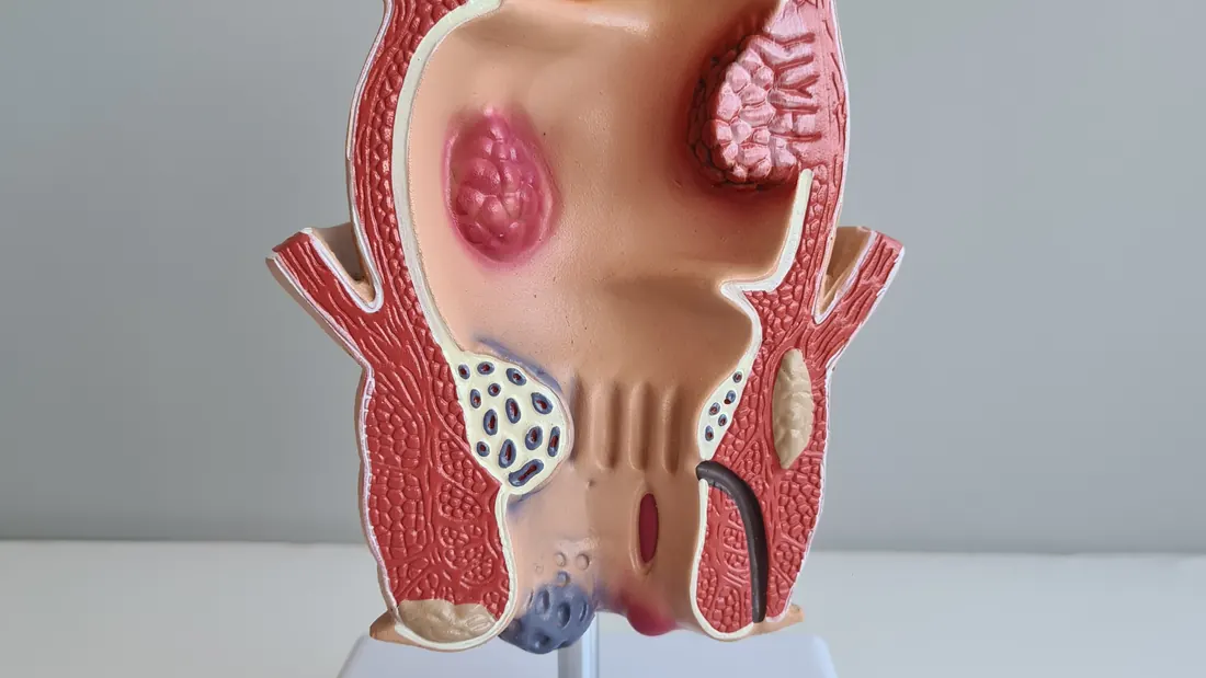 Câncer de Canal Anal: Causas, Sintomas, Diagnóstico e Tratamento · imagem ilustrativa
