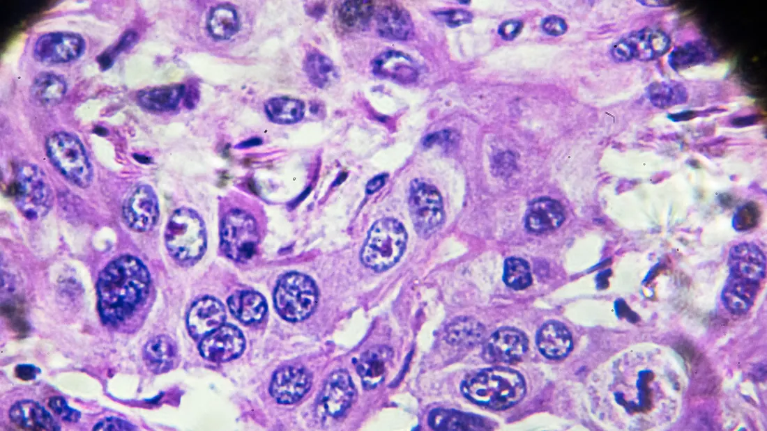 Carcinoma Hepatocelular: O Que É, Fatores de Risco, Diagnóstico e Tratamento · imagem ilustrativa