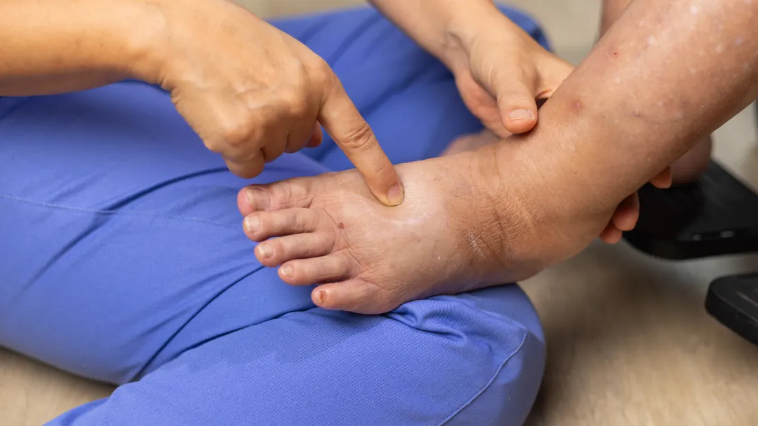 Linfedema Oncológico: Causas, Sintomas e Como Prevenir · imagem ilustrativa